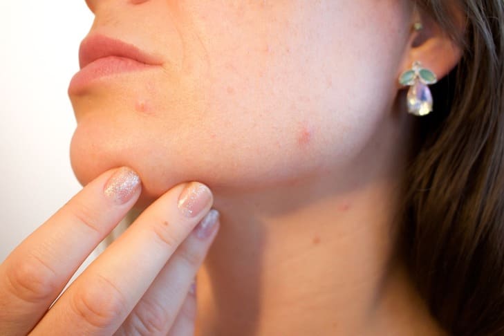 pelle del viso con acne